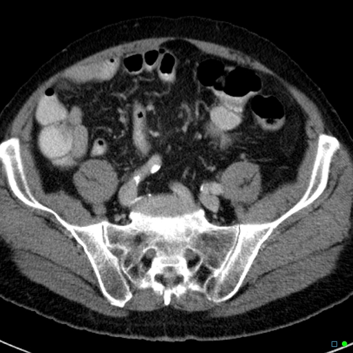 File:Acute appendicitis arising from a malrotated cecum (Radiopaedia 19970-19997 Axial C+ portal venous phase 32).jpg