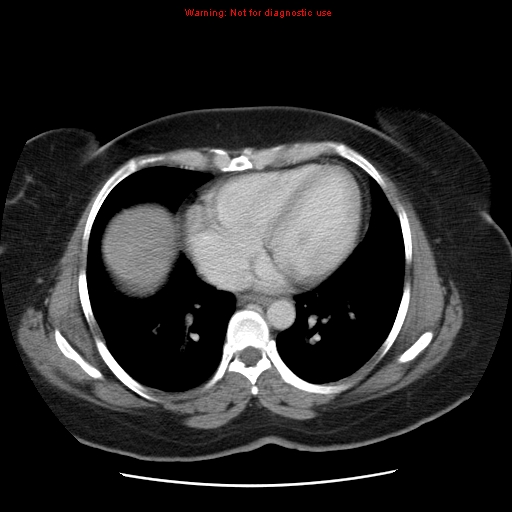 Acute appendicitis complicated by ovarian vein thrombophlebitis (Radiopaedia 16172-15851 Axial C+ portal venous phase 8).jpg