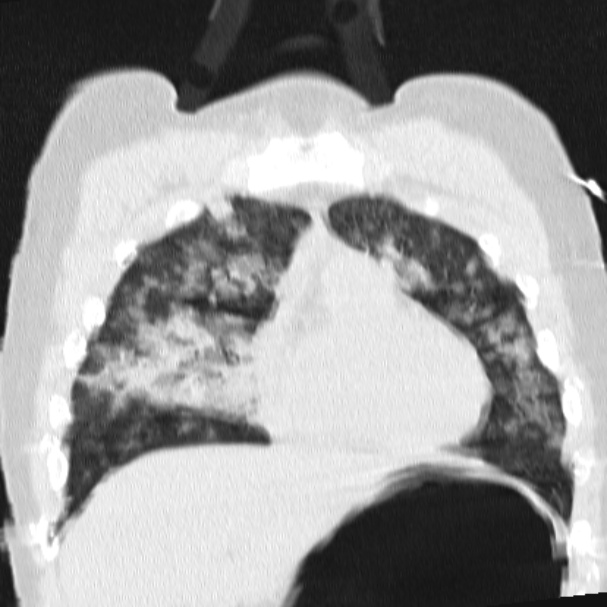 Acute aspiration pneumonitis (Radiopaedia 33605-34703 Coronal lung window 29).jpg