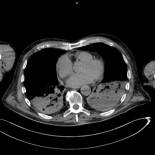 Acute aspiration pneumonitis (Radiopaedia 55642-62166 Axial liver window 41).jpg