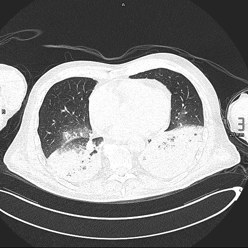 Acute aspiration pneumonitis (Radiopaedia 55642-62166 Axial lung window 104).jpg