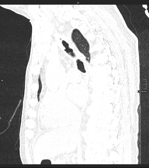 Acute aspiration pneumonitis (Radiopaedia 55642-62166 Sagittal lung window 84).jpg
