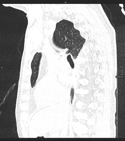 Acute aspiration pneumonitis (Radiopaedia 55642-62166 Sagittal lung window 90).jpg
