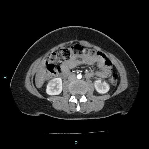 Acute bilateral pyelonephritis (Radiopaedia 37146-38881 Axial C+ arterial phase 100).jpg