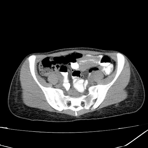 Acute bilateral pyelonephritis (Radiopaedia 74153-84969 Axial non-contrast 38).jpg