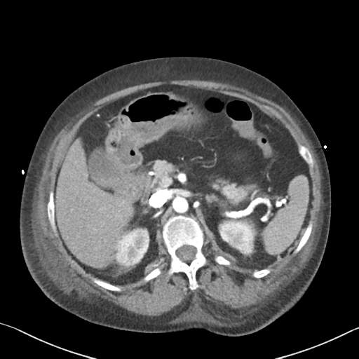 File:Acute bleed from gastric fundus biopsy site (Radiopaedia 35201-36737 Axial C+ arterial phase 25).png