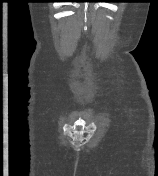 Acute bleed from gastric fundus biopsy site (Radiopaedia 35201-36737 Coronal C+ arterial phase 52).png