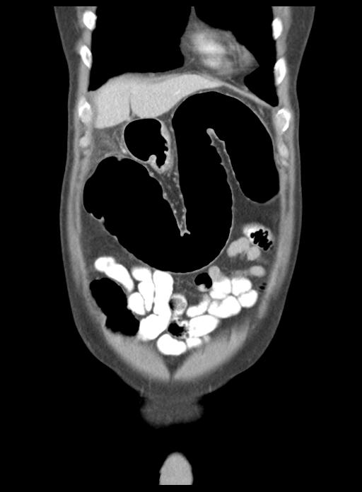 Acute cholecystitis (Radiopaedia 29814-30327 Coronal C+ portal venous phase 12).jpg
