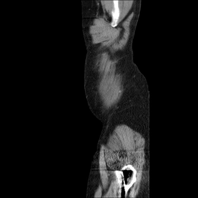 Acute cholecystitis and incidental left sided IVC (Radiopaedia 49352-54459 Sagittal C+ portal venous phase 86).jpg