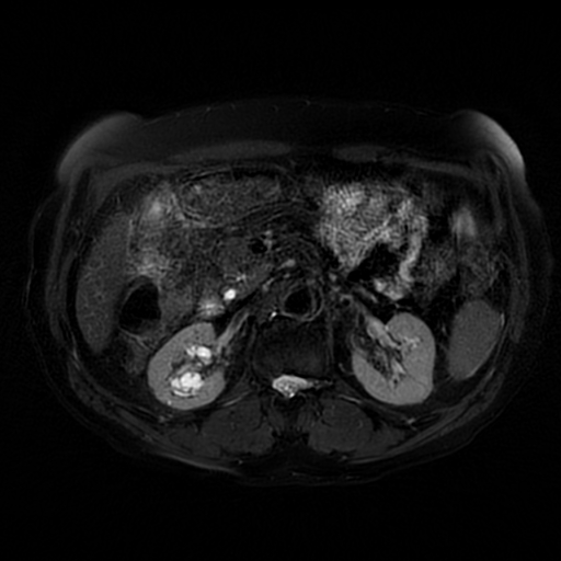 File:Acute cholecystitis complicated by pylephlebitis (Radiopaedia 65782-74915 Axial T2 fat sat 27).jpg