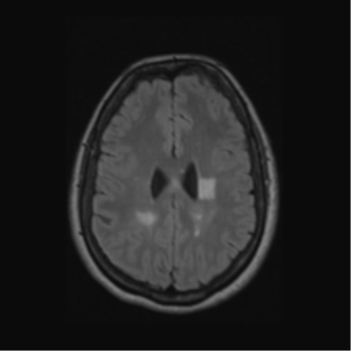 Acute disseminated encephalomyelitis (ADEM) (Radiopaedia 38073-40065 Axial FLAIR 44).png