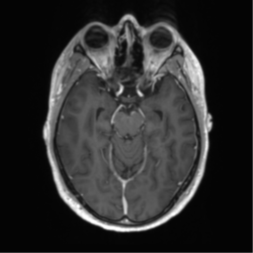 Acute disseminated encephalomyelitis (ADEM) (Radiopaedia 65319-74350 Axial T1 C+ 20).png