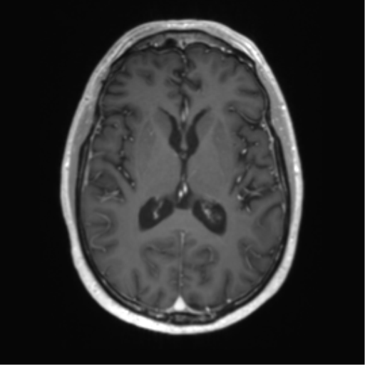 Acute disseminated encephalomyelitis (ADEM) (Radiopaedia 65319-74350 Axial T1 C+ 33).png