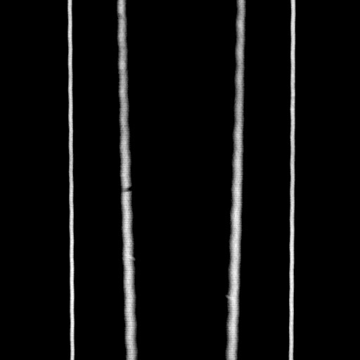 Acute diverticulitis - transverse colon (Radiopaedia 87063-103327 Coronal C+ portal venous phase 175).jpg