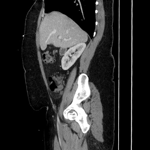 Acute diverticulitis - transverse colon (Radiopaedia 87063-103327 Sagittal C+ portal venous phase 89).jpg