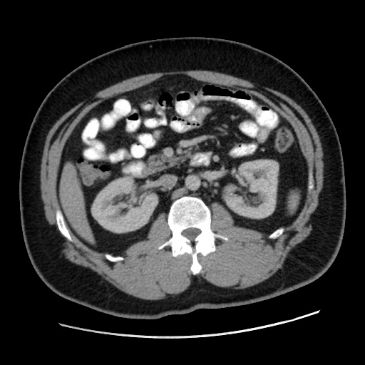 Acute diverticulitis with localized perforation (Radiopaedia 41296-44113 Axial C+ portal venous phase 38).jpg