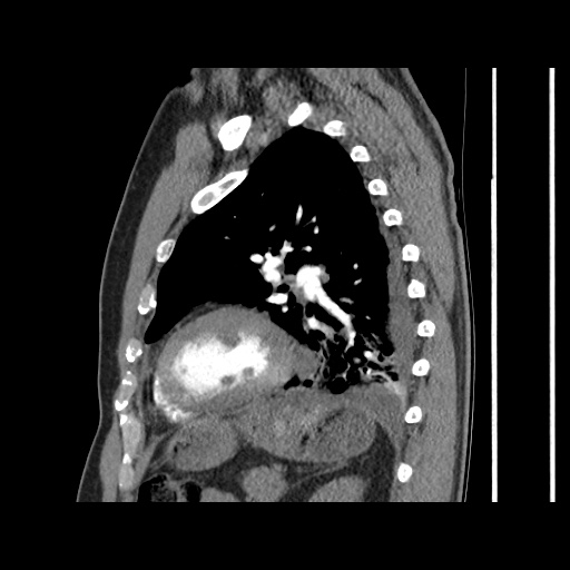 Acute epicardial fat necrosis (Radiopaedia 42327-45440 Sagittal C+ CTPA 49).jpg