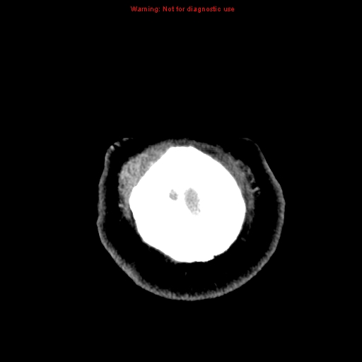 File:Acute hemorrhagic leukoencephalitis (Radiopaedia 14076-72275 Axial non-contrast 47).jpg