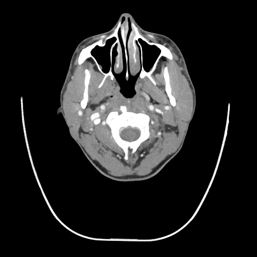Acute longus colli calcific tendinitis (Radiopaedia 72495-83036 Axial C+ arterial phase 21).jpg