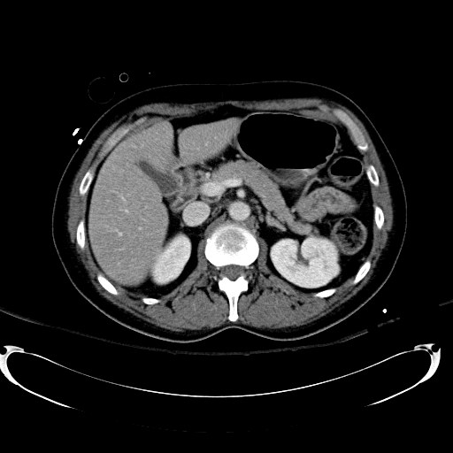 Acute myocardial infarction in CT (Radiopaedia 39947-42415 Axial C+ portal venous phase 43).jpg