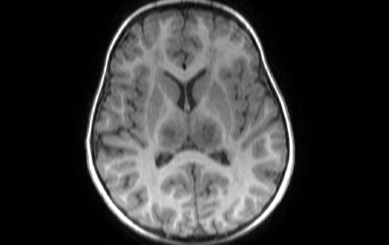 Acute necrotizing encephalitis of childhood (Radiopaedia 67356-76737 Axial T1 43).jpg