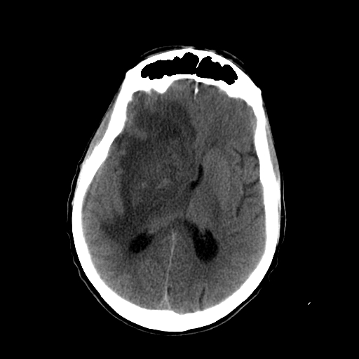 File:Acute necrotizing toxoplasma encephalitis (Radiopaedia 10683-11150 Axial non-contrast 17).jpg