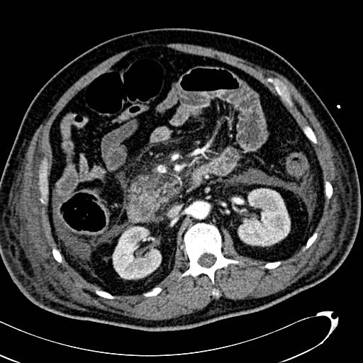 File:Acute pancreatic necrosis (Radiopaedia 13560-13486 Axial C+ portal venous phase 68).jpg