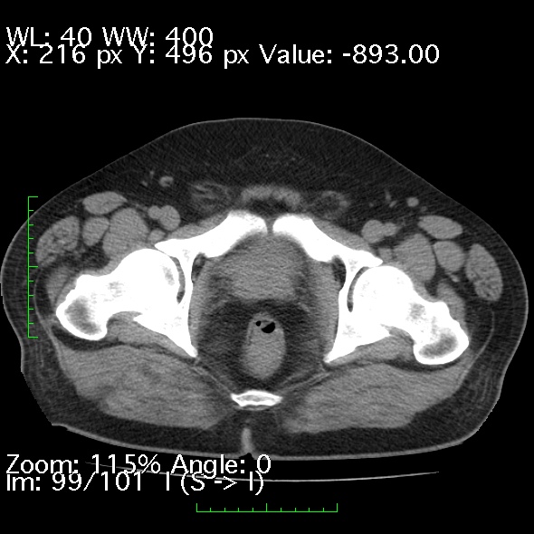 Acute pancreatitis (Radiopaedia 34043-35276 Axial non-contrast 99).jpg