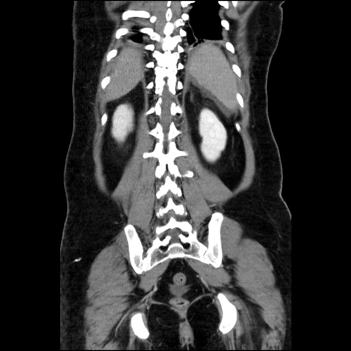 Acute pancreatitis (Radiopaedia 69236-79012 Coronal C+ portal venous phase 24).jpg