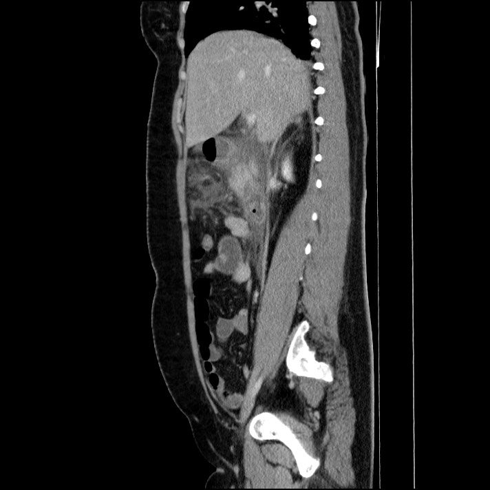 Acute pancreatitis (Radiopaedia 69236-79012 Sagittal C+ portal venous phase 64).jpg