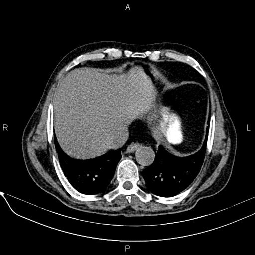 File:Acute pancreatitis (Radiopaedia 85146-100701 Axial non-contrast 19).jpg
