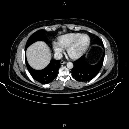 File:Acute pancreatitis (Radiopaedia 85390-101010 Axial C+ portal venous phase 8).jpg