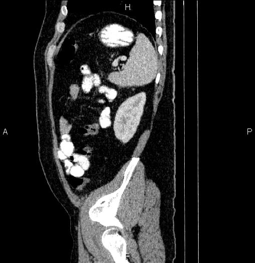 Acute pancreatitis (Radiopaedia 85390-101010 Sagittal C+ portal venous phase 85).jpg
