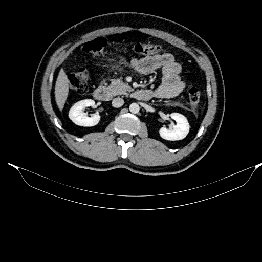 Acute pancreatitis (Radiopaedia 87428-103757 Axial C+ portal venous phase 44).jpg