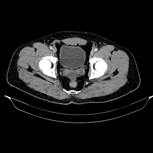 Acute pancreatitis (Radiopaedia 87428-103757 Axial C+ portal venous phase 90).jpg
