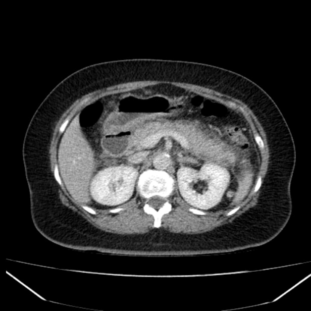 Acute pancreatitis - Balthazar C (Radiopaedia 26569-26714 Axial C+ portal venous phase 38).jpg