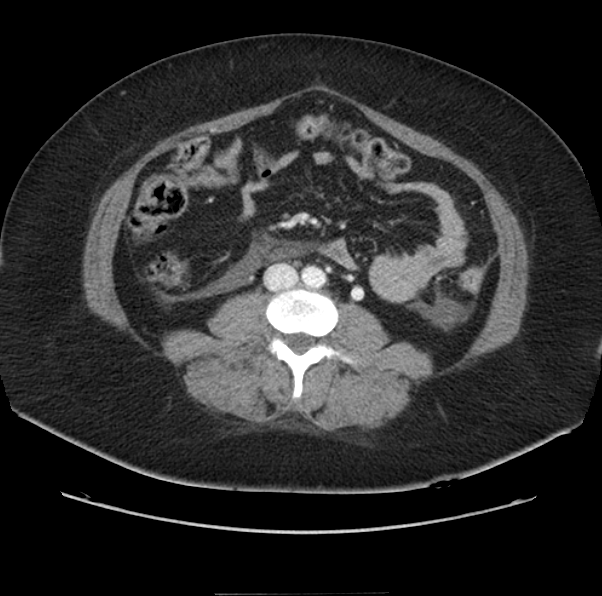 Acute pancreatitis - Balthazar E (Radiopaedia 29016-29377 Axial C+ portal venous phase 40).png