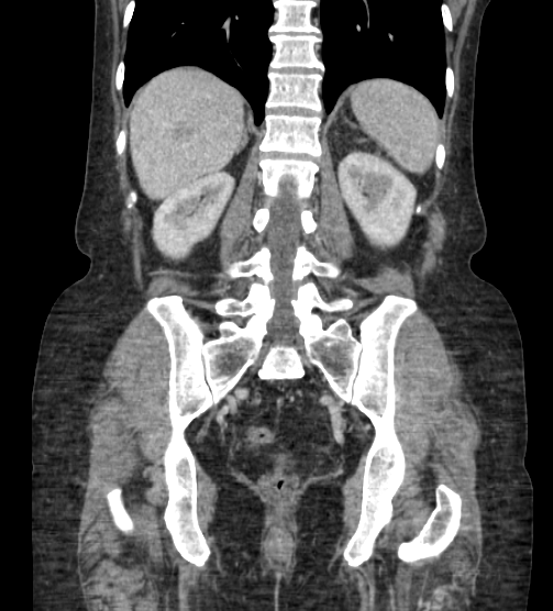 File:Acute pancreatitis - Balthazar E - post ERCP (Radiopaedia 27562-27772 Coronal C+ portal venous phase 64).png