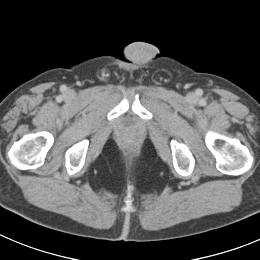 Acute pancreatitis and walled-off necrosis (Radiopaedia 29888-30403 Axial C+ delayed 85).jpg