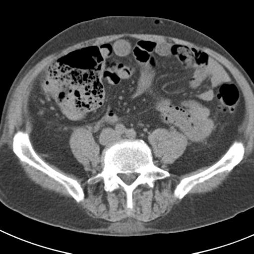 File:Acute pancreatitis and walled-off necrosis (Radiopaedia 29888-30403 Axial non-contrast 49).jpg