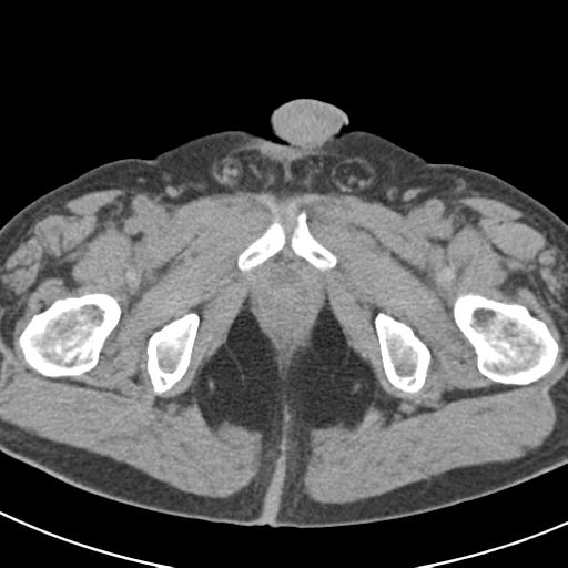 File:Acute pancreatitis and walled-off necrosis (Radiopaedia 29888-30403 Axial non-contrast 79).jpg