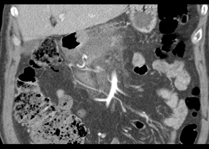 Acute pancreatitis and walled-off necrosis (Radiopaedia 29888-30403 Coronal C+ portal venous phase 22).jpg