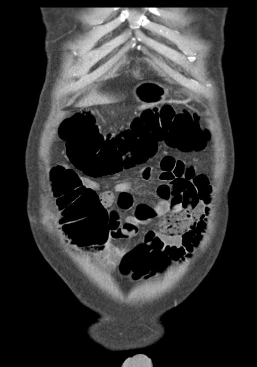Acute pancreatitis and walled-off necrosis (Radiopaedia 29888-30403 E 11).jpg
