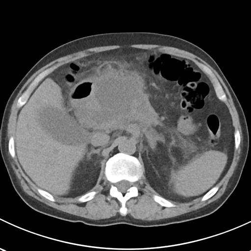 File:Acute pancreatitis and walled-off necrosis (Radiopaedia 29888-30404 Axial non-contrast 24).jpg