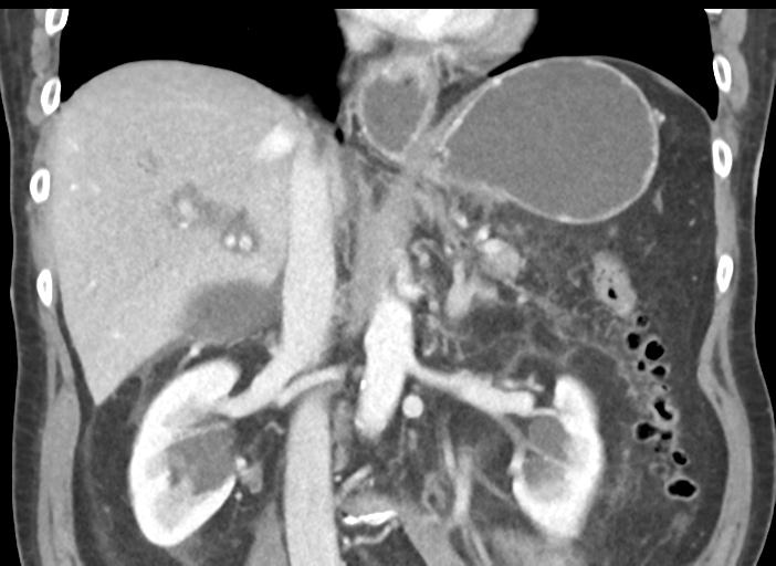 Acute pancreatitis and walled-off necrosis (Radiopaedia 29888-30404 Coronal C+ portal venous phase 30).jpg
