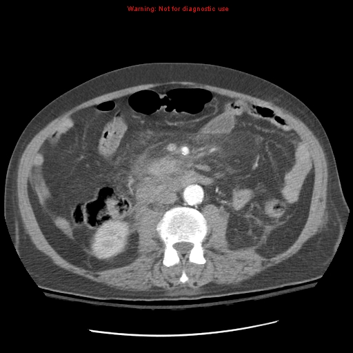 Acute pancreatitis with incidental pancreatic lipoma (Radiopaedia 10190-10730 Axial C+ arterial phase 55).jpg