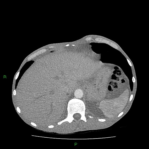 File:Acute right lung abscess (Radiopaedia 34806-36258 Axial C+ arterial phase 168).jpg