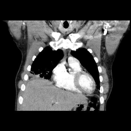 Acute segmental pulmonary emboli and pulmonary infarction (Radiopaedia 62264-70444 Coronal C+ CTPA 10).jpg