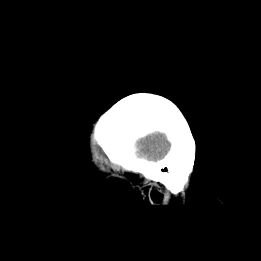Acute subarachnoid hemorrhage and accessory anterior cerebral artery (Radiopaedia 69231-79008 Sagittal non-contrast 7).jpg