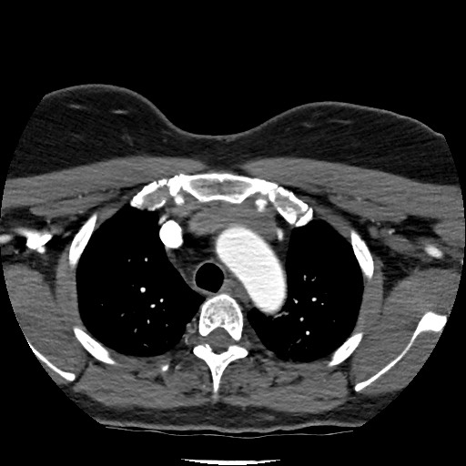 Acute subarachnoid hemorrhage and accessory anterior cerebral artery (Radiopaedia 69231-79009 Axial C+ arterial phase 15).jpg